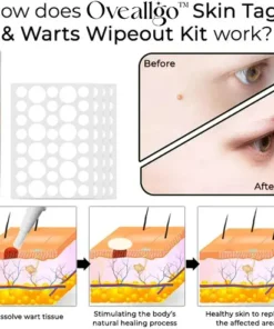 Oveallgo™ Skin Tags & Warts Wipeout Kit