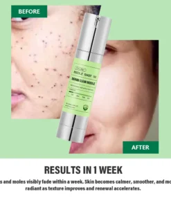 Oveallgo® Korean DermaClear Reedle Shot 100 Wart & Mole Eraser Serum