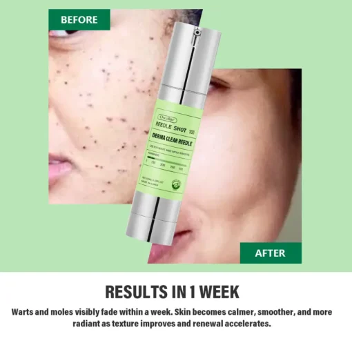 Oveallgo® Korean DermaClear Reedle Shot 100 Wart & Mole Eraser Serum