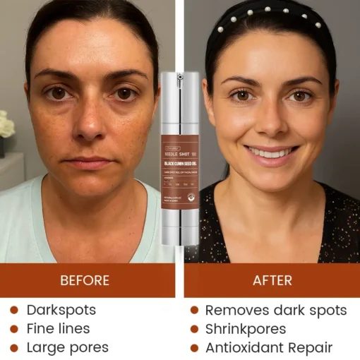 Oveallgo® Korean HerbErase Reedle Shot 100 Black Cumin Seed Oil Dark Spot Peel-Off Facial Mask