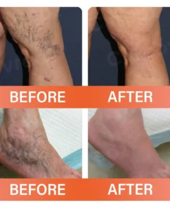 Oveallgo® VeinEase Microneedle Therapy Patch