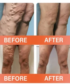 Oveallgo® VeinEase Microneedle Therapy Patch