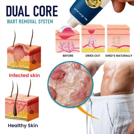 Oveallgo® Genital Warts Remover Cream