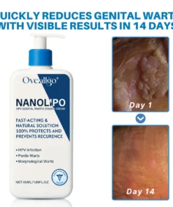 Oveallgo® NanoLipo HPV Genital Warts Eraser Cream