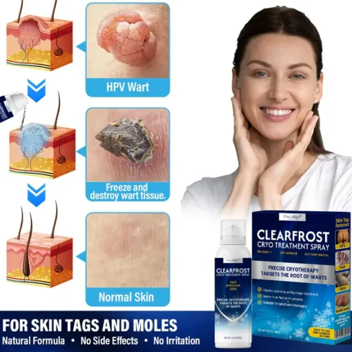 Oveallgo® ClearFrost Cryo Treatment Spray