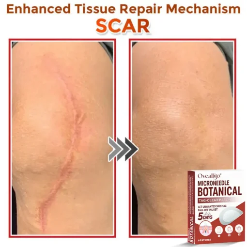 Oveallgo® MicroNeedle Botanical Tag-Clear Patch Pro
