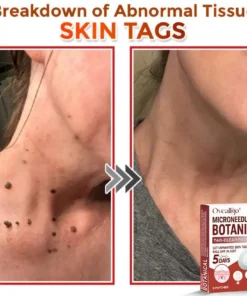 Oveallgo® MicroNeedle Botanical Tag-Clear Patch Pro