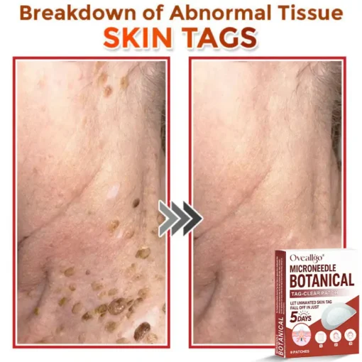 Oveallgo® MicroNeedle Botanical Tag-Clear Patch Pro