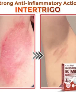 Oveallgo® MicroNeedle Botanical Tag-Clear Patch Pro