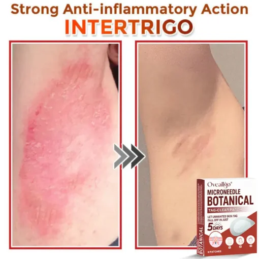 Oveallgo® MicroNeedle Botanical Tag-Clear Patch Pro