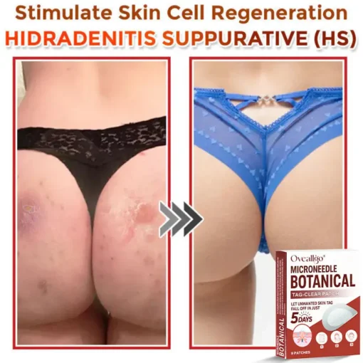 Oveallgo® Intensive MicroNeedle Botanical Tag-Clear Patch