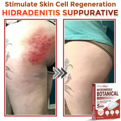 Oveallgo® Intensive MicroNeedle Botanical Tag-Clear Patch