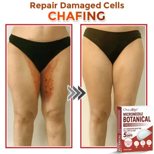 Oveallgo® Intensive MicroNeedle Botanical Tag-Clear Patch