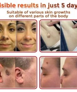Oveallgo® Intensive MicroNeedle Botanical Tag-Clear Patch