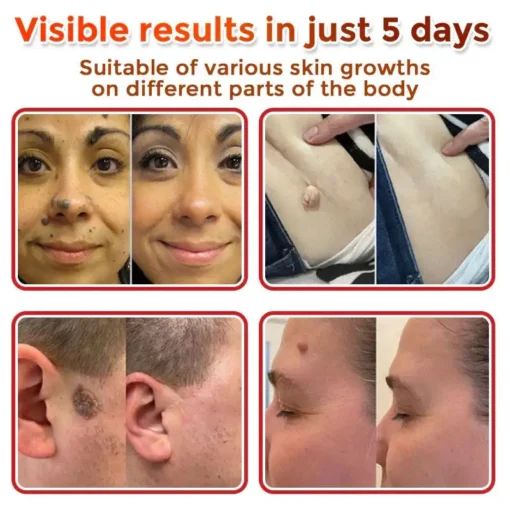 Oveallgo® Intensive MicroNeedle Botanical Tag-Clear Patch