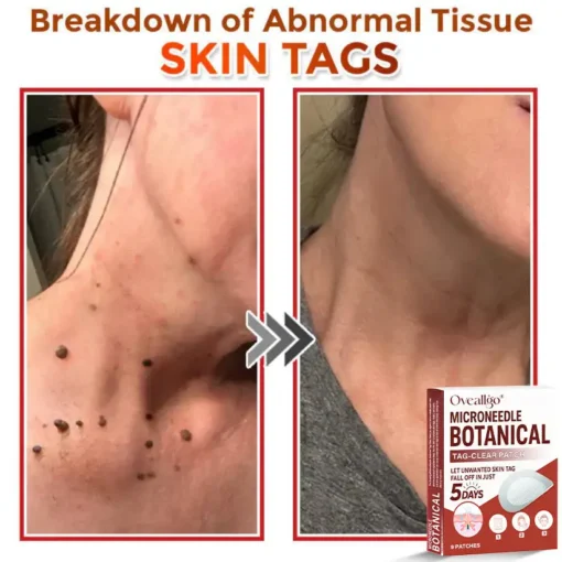 Oveallgo® Intensive MicroNeedle Botanical Tag-Clear Patch