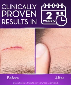 Oveallgo® Advanced Scar Gel