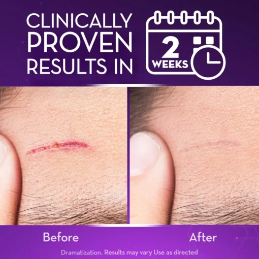 Oveallgo® Advanced Scar Gel