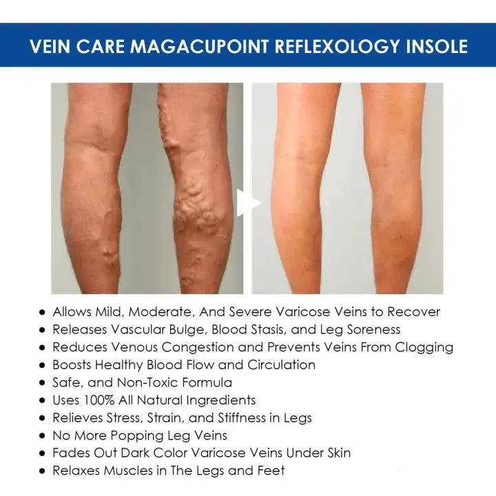 Oveallgo™ VeinCare MagAcupoint Reflexology Insole