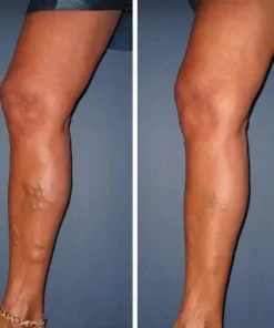 Oveallgo™ VeinCare MagAcupoint Reflexology Insole