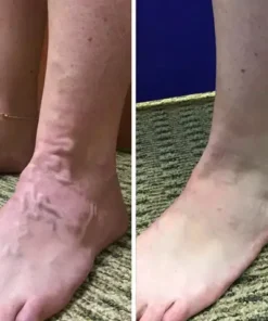 Oveallgo™ VeinCare MagAcupoint Reflexology Insole