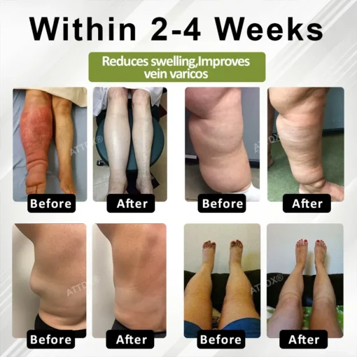 Oveallgo® VeinoRoll Therapy Edema Comfort Cream