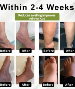 Oveallgo® VeinoRoll Therapy Edema Comfort Cream