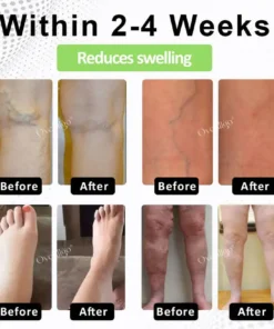 Oveallgo® CircuPro Edema & Lymphatic Support Inhaler