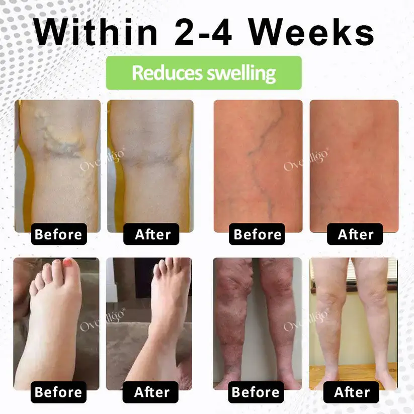 Oveallgo® CircuPro Edema & Lymphatic Support Inhaler