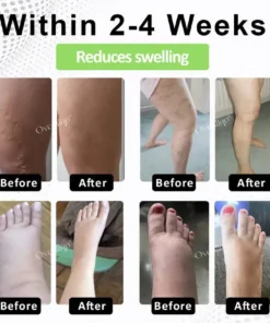 Oveallgo® CircuPro Edema & Lymphatic Support Inhaler