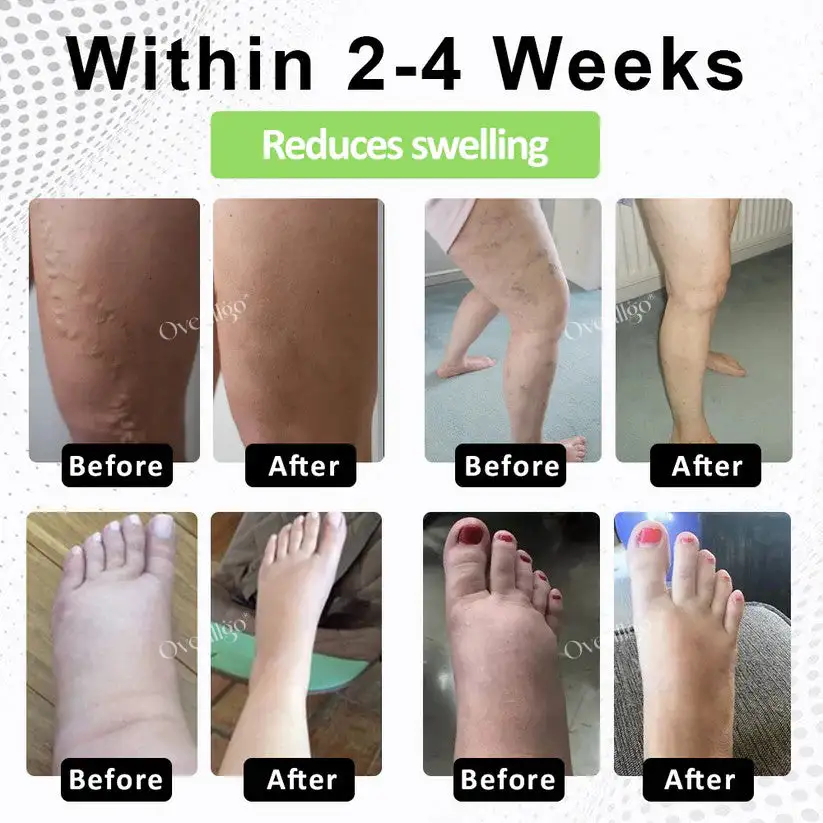 Oveallgo® CircuPro Edema & Lymphatic Support Inhaler