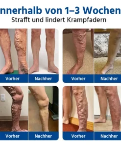 Oveallgo® 𝐕𝐞𝐢𝐧𝐓𝐚𝐫𝐠𝐞𝐭 𝐌𝐢𝐜𝐫𝐨𝐧𝐞𝐞𝐝𝐥𝐞 𝐏𝐚𝐭𝐜𝐡